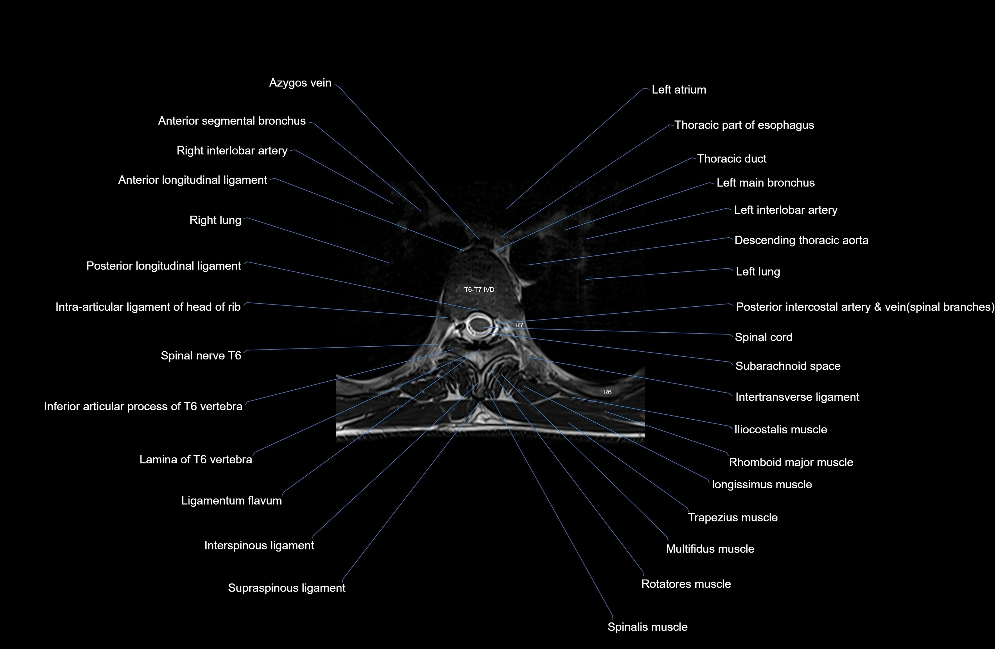 MRI thoracic spine axial  cross sectional anatomy 3T radiology  image-img-00001-00041.webp